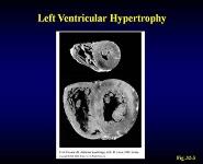 Hypertension PowerPoint Presentation Notes