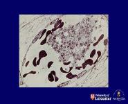 Haemostasis Thrombosis and Embolism PowerPoint Presentation