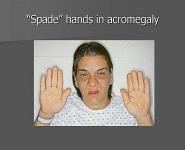 Valvular Heart Disease and the Cardiac Exam PowerPoint Presentation Notes