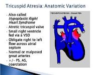 Congenital Heart Disease: Outcome in Patients with Single Ventricle PowerPoint Presentation