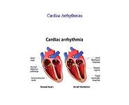 Cardiac Arrhythmias PowerPoint Presentation