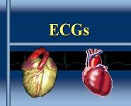 ECGs PowerPoint Presentation