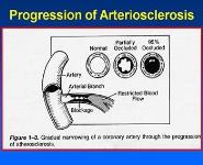 Arteriosclerosis and Coronary Heart Disease (CHD) PowerPoint Presentation