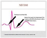 Acute Coronary Syndrome Update PowerPoint Presentation Notes