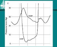 Valvular Heart Disease Mitral Stenosis PowerPoint Presentation Notes