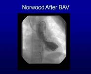 Balloon Aortic Valvuloplasty in Infants and Children PowerPoint Presentation