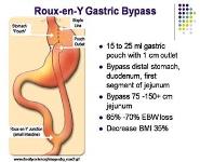 Complications and Benefits of Bariatric Surgery PowerPoint Presentation