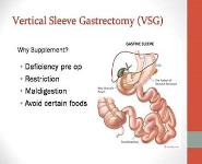 Nutrition and Weight Loss Surgery PowerPoint Presentation Notes