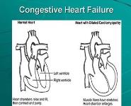 Congestive Heart Failure Case Study PowerPoint Presentation Notes