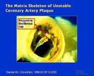 Pathogenesis of Acute Coronary Syndromes PowerPoint Presentation