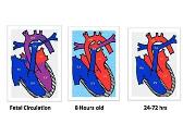 Congenital Heart Disease (CHD)