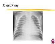 Congestive Heart Failure in Children PowerPoint Presentation Notes