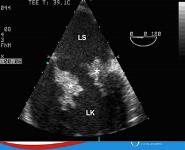 Infectious heart diseases PowerPoint Presentation