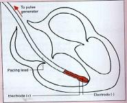 Cardiac Assist Devices PowerPoint Presentation