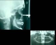 Complete and Partial Edentulism PowerPoint Presentation Notes