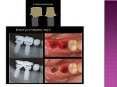 Guidelines and Rationale of Abutment Selection and Designing in Implant Prosthodontics
