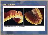 Removable Prosthodontics