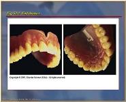 Removable Prosthodontics PowerPoint Presentation Notes