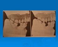 Single complete denture PowerPoint Presentation