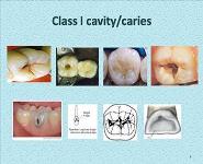 Classification of cavities PowerPoint Presentation