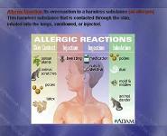 Allergy: An Overview PowerPoint Presentation Notes