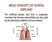 Basic concept of dental implant PowerPoint Presentation Notes