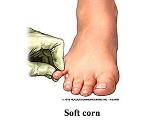 Corns and Calluses