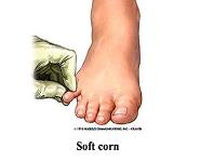 Corns and Calluses PowerPoint Presentation Notes