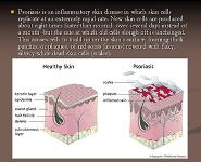 PSORIASIS PowerPoint Presentation Notes