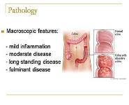 Inflammatory Bowel Disease - Ulcerative colitis (UC) PowerPoint Presentation