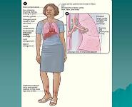 Sarcoidosis PowerPoint Presentation