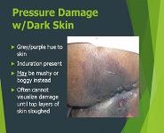 Pressure Ulcers Injuries Assessment and Treatment PowerPoint Presentation Notes