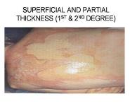 BURNS PowerPoint Presentation Notes