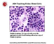 Hodgkins lymphoma PowerPoint Presentation