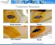 Hyperhidrosis PowerPoint Presentation