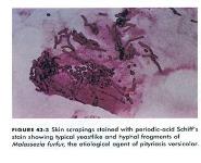 Mycotic Infections PowerPoint Presentation