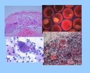 Herpes Simplex Virus I - Cold Sores and Fever Blisters PowerPoint Presentation