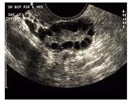 Hirsutism and Virilization PowerPoint Presentation