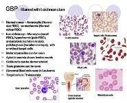 Anemia in Pregnancy PowerPoint Presentation