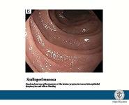 Celiac Disease and Gluten Sensitivity PowerPoint Presentation Notes