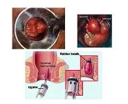 Anal Canal Fissure In Ano Haemorrhoids PowerPoint Presentation Notes
