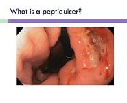 Peptic ulcer disease PowerPoint Presentation Notes