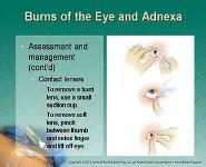 Diseases of the Eyes Ears Nose and Throat PowerPoint Presentation Notes