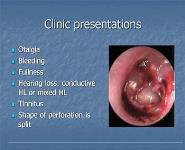 Perforation of tympanic membrane PowerPoint Presentation