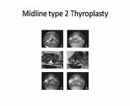 Neurogenic Voice Disorders PowerPoint Presentation Notes