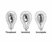 Spontaneous abortion PowerPoint Presentation