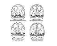 Multiple Pregnancy PowerPoint Presentation
