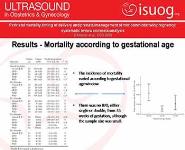 Perinatal mortality timing of delivery and prenatal management of monoamniotic twin pregnancy PowerPoint Presentation