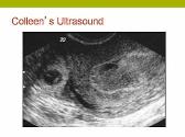 First Trimester Bleeding