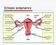 Bleeding in Early Pregnancy PowerPoint Presentation